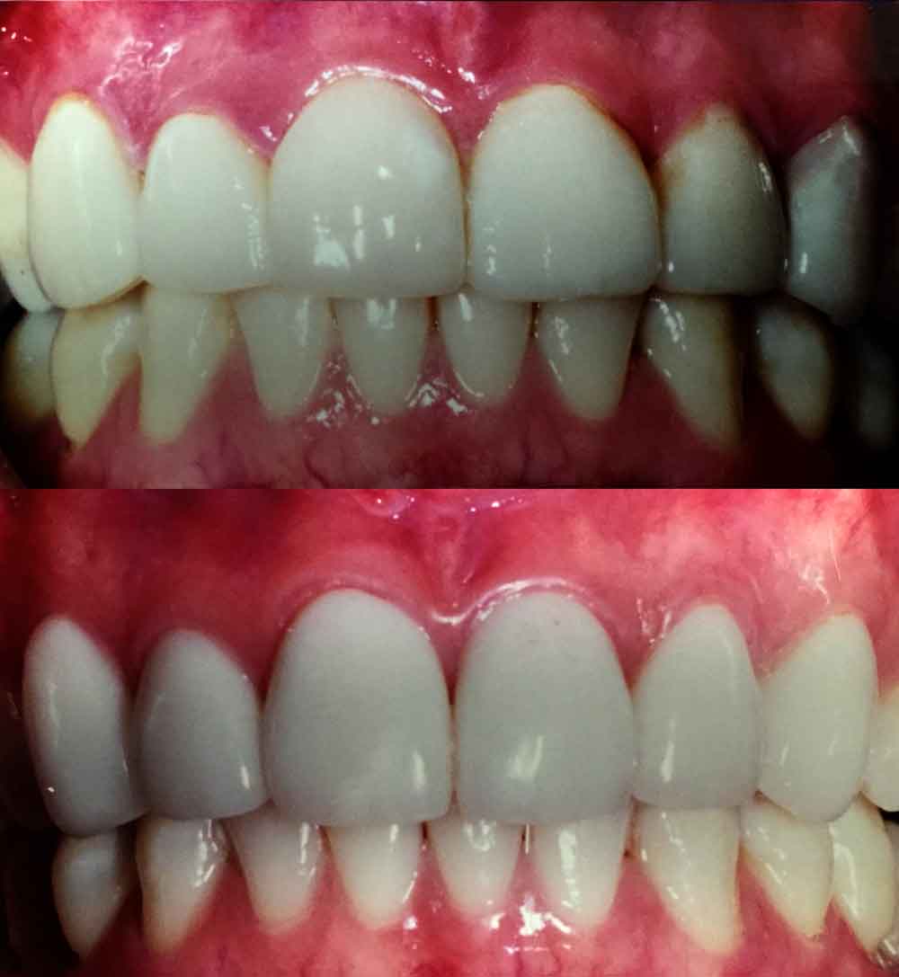 New Porcelain Veneers on upper 6 front teeth (replacing old veneers)